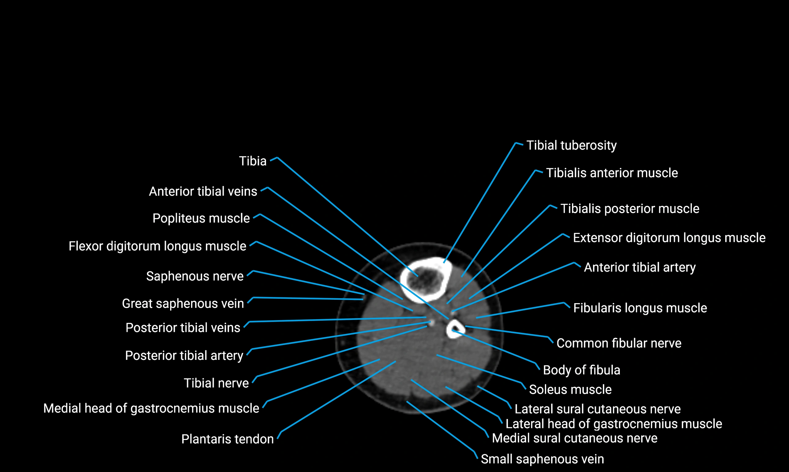 CT lower limb axial cross sectional anatomy labelled image 103 (2).webp
